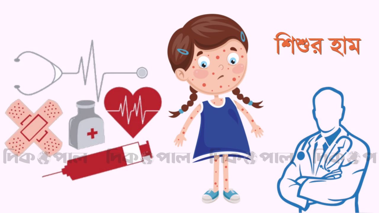 দেশে আশঙ্কাজনক হারে বাড়ছে হাম: ২৪ ঘণ্টায় ৪ মৃত্যু, নতুন আক্রান্ত ১১৭৭