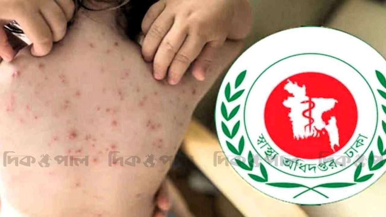 হাম ও হামের উপসর্গে একদিনে ১১ জনের মৃত্যু: জনস্বাস্থ্য নিয়ে উদ্বেগ